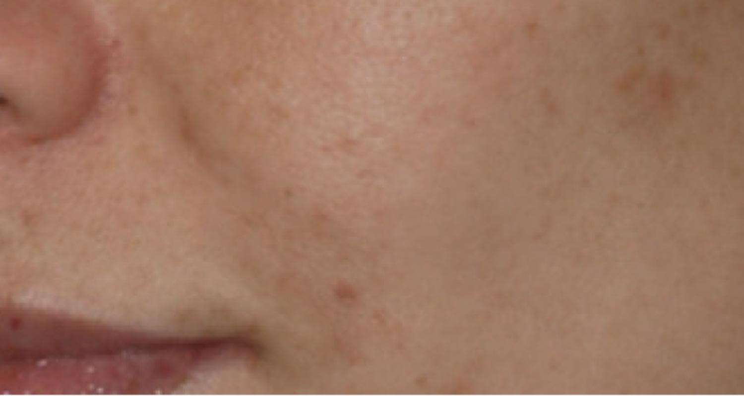 IPL Photo Laser Skin Rejuvenation | Dr. R. Mokbel Clinic