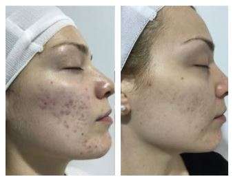 medical needling- before and after