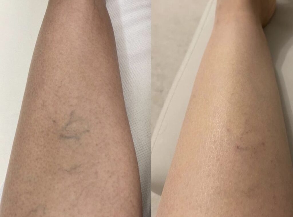 Thread veins before and after
